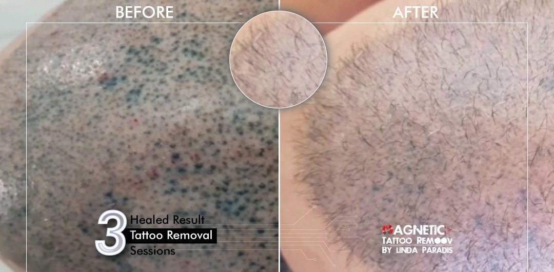 Non-Invasive Magnetic Tattoo Removal Technique by Linda Paradis