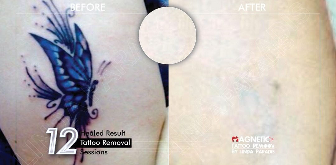 Non-Invasive Magnetic Tattoo Removal Technique by Linda Paradis