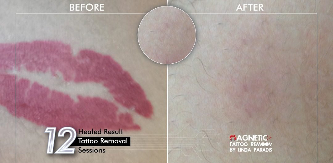 Non-Invasive Magnetic Tattoo Removal Technique by Linda Paradis