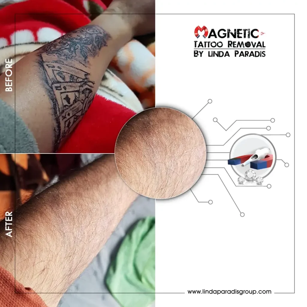 Magnetic Tattoo Removal body tattoo Before and After