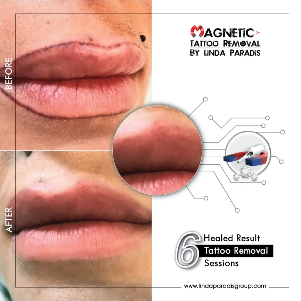 Lips Contour Tattoo Removal Before and After