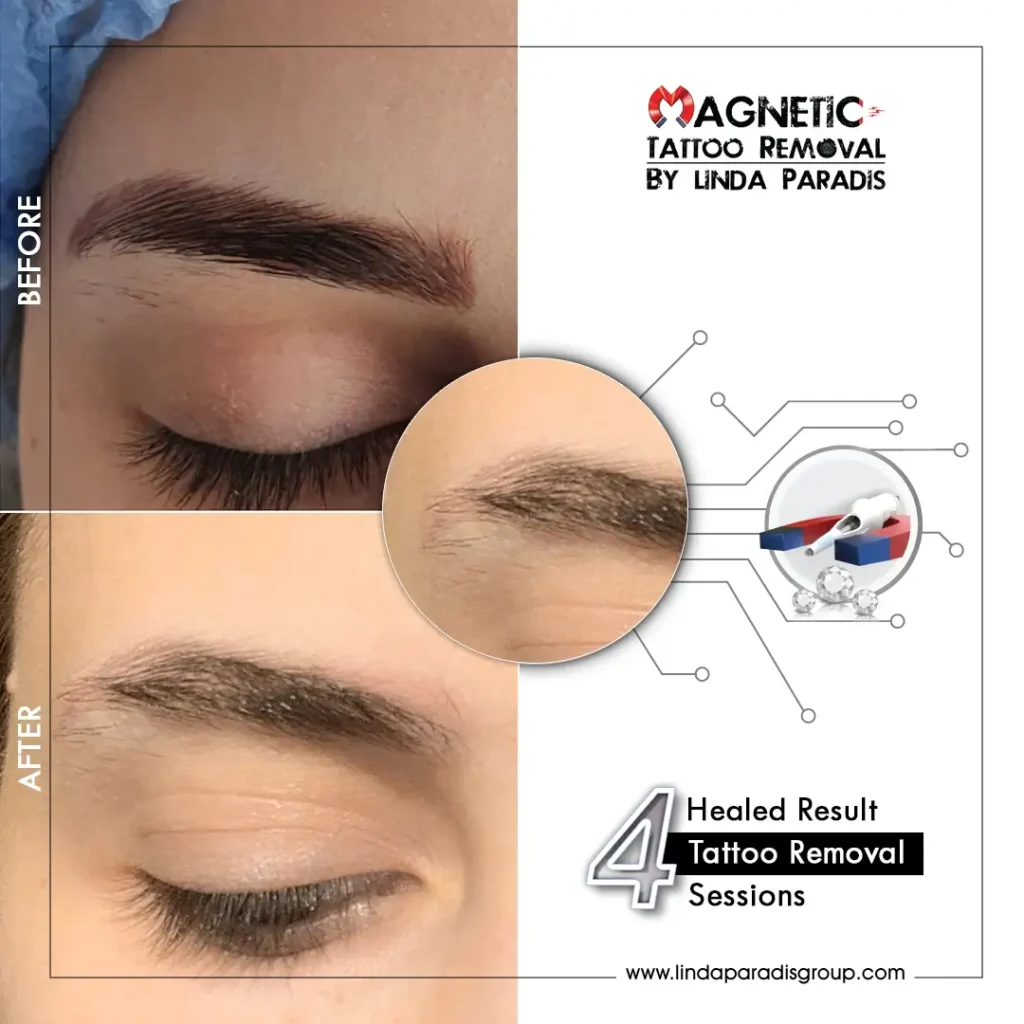 Microblading Removal Before and After 1