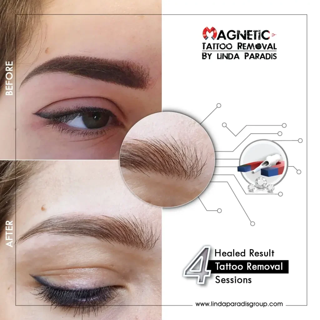 Microblading Removal Before and After 3