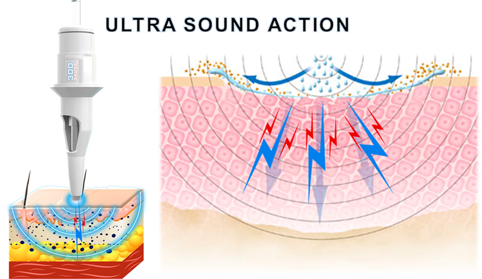 Ultrasound & Ultrasonic action