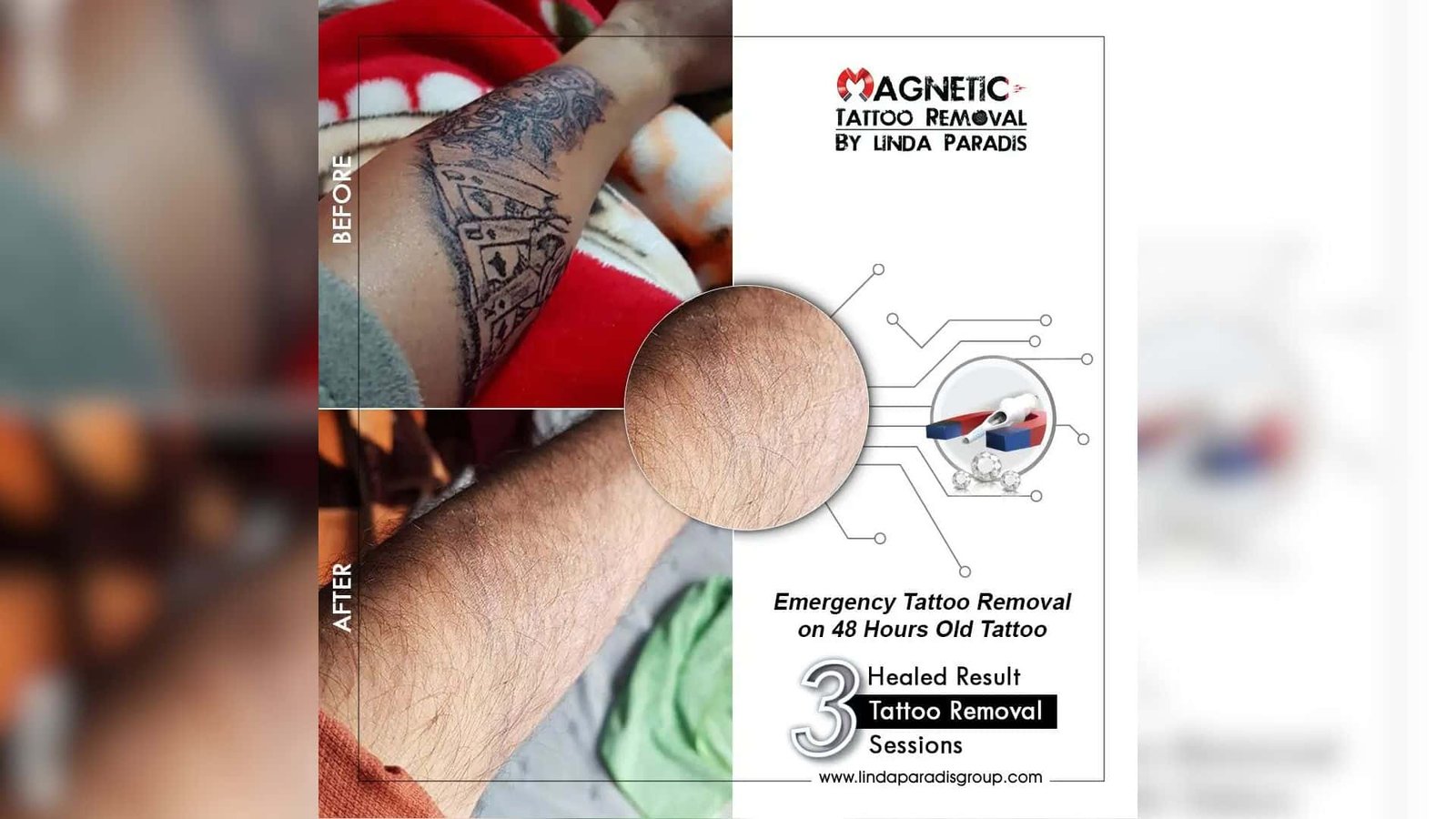 Magnetic Tattoo Removal is Effective on removing emergency tattoos