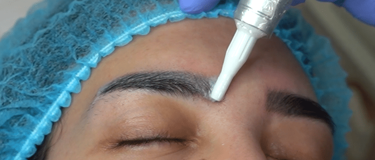 Common Mistakes in Tattoo Removal