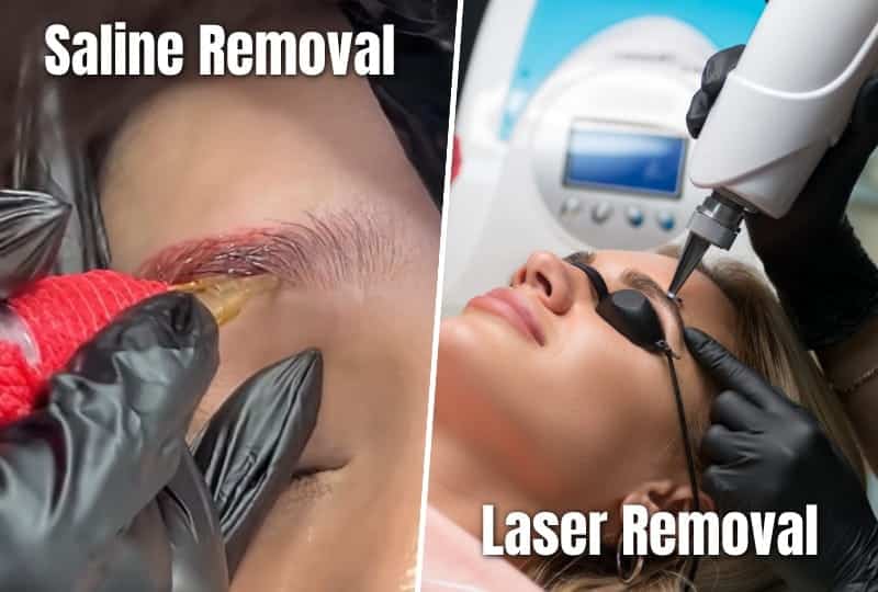 Saline and Laser tattoo removal