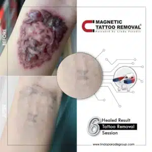 Body Tattoo Removal Before and After