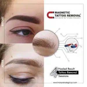 Microblading Tattoo Removal Before and After