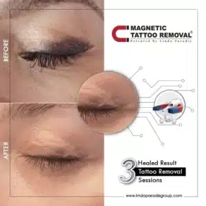 Eyeliner Tattoo Removal Before and After