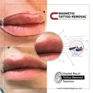 Lips Contour Tattoo Removal Before and After