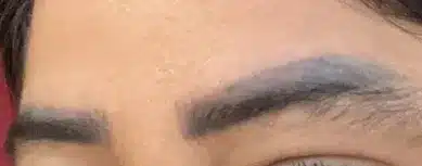 Eyebrows three weeks after the third MTR session showing further pigment reduction