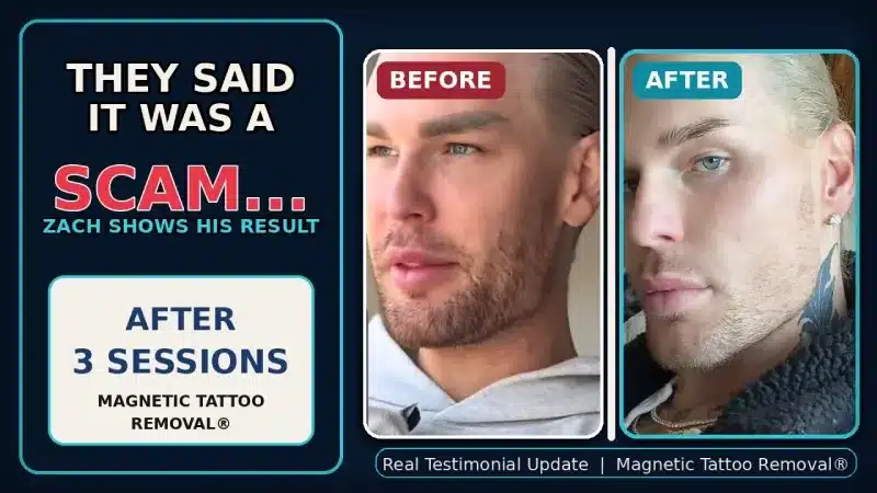Zach Mesquit Update on Magnetic Tattoo Removal After One Session