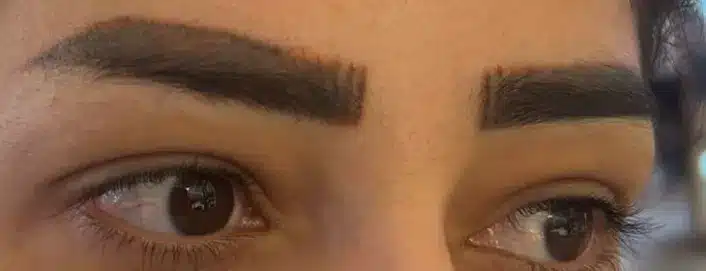 Dense, dark multi-layer eyebrow permanent makeup before Magnetic Tattoo Removal treatment