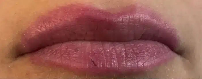 Heavily saturated purple-toned lip tattoo extending beyond the natural lip line before Magnetic Tattoo Removal treatment