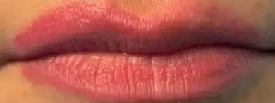 Lips after an early MTR session, healed, with remaining pigment on the lip border