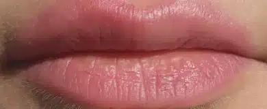 Lips healed after a further MTR session with reduced pigment saturation