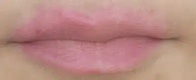 Lips healed later in the sequence showing a lighter pink tone