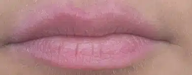 Lips healed near the end of the sequence with minimal residual pigment