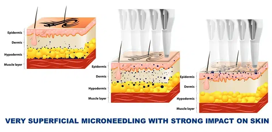 Magnetic cartridge and E-Dermis Ink Extractor, surface application