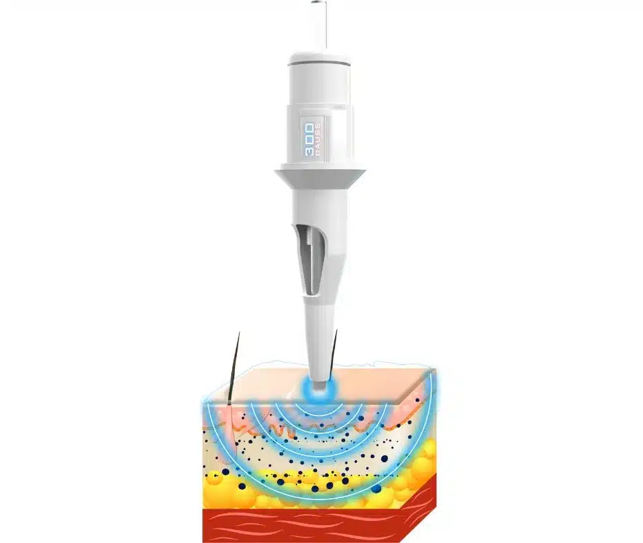 Magnetic Tattoo Removal Technique