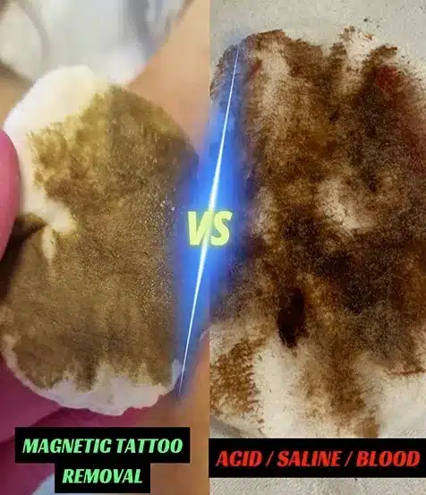 magnetic tattoo-removal vs saline tattoo removal
