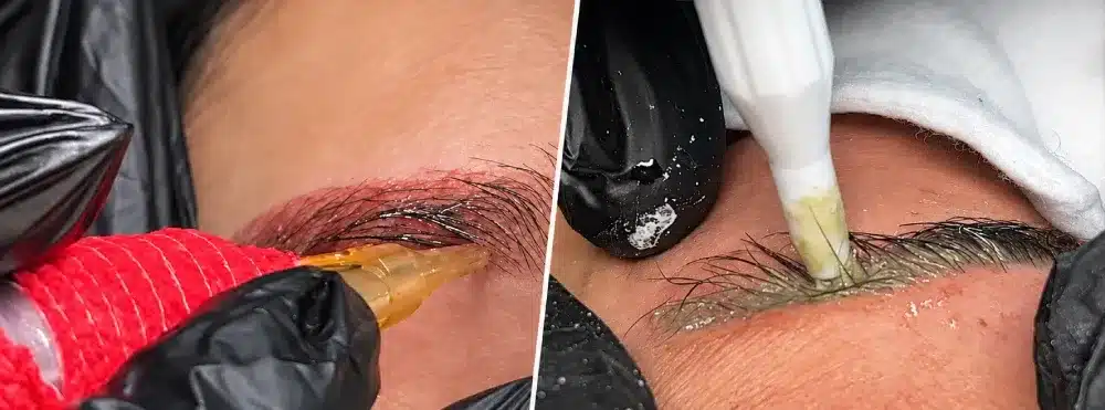 Magnetic Tattoo Removal® vs. saline tattoo removal comparison