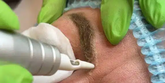 Yellow Eyebrow Microblading Removal
