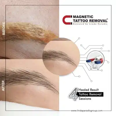 Yellow Eyebrow Removal Before After